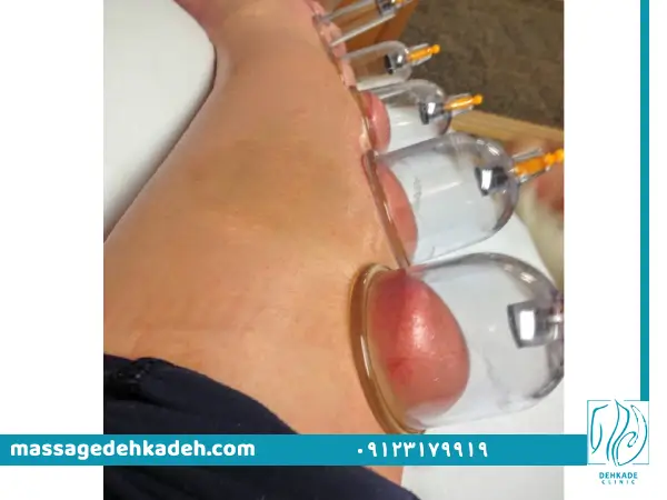 بادکش درمانی در کرج