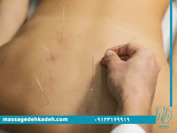 طب سوزنی