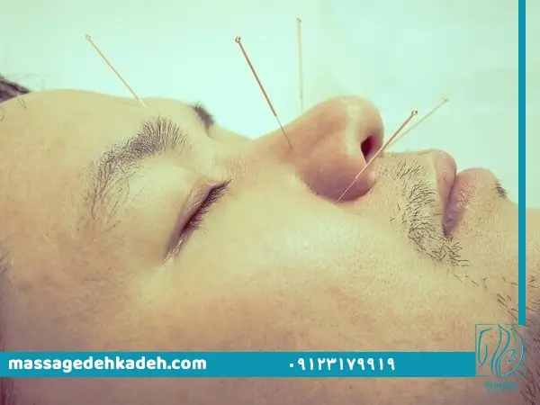 طب سوزنی