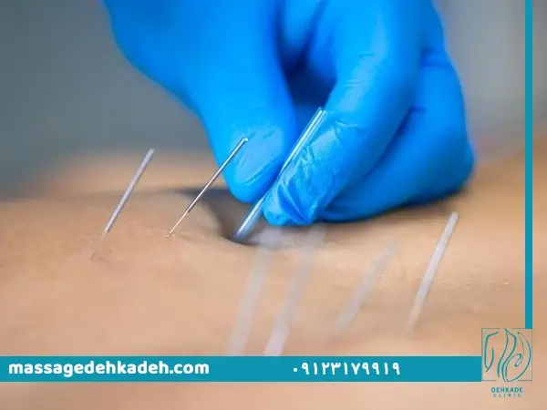 طب سوزنی